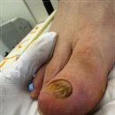 무드비네일닥터아이티엔내성발톱무좀발각질