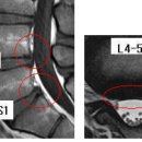 슈슈슝 님의 요추 MRI 사진 판독입니다. 이미지