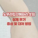 아야진약국 | [노무라입깃해파리 쏘인 후기] 강원도 고성 해수욕장 해파리 쏘였을 때, 쏘임 증상 및 응급처치 대처 방법