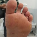 유리아필라테스 | 발각질 유리아 크림 쓰기전 이거모르면 효과없음ㅠ(+원인)