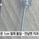 수면 임플란트 했다 봉변...목에서 1cm 수술 도구 '툭' 이미지