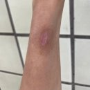 2도 | 심재성 2도 저온화상 치료후기 #4 흉터관리