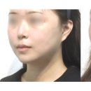 슈어스성형외과의원 | 대구 리프트성형외과에서 추천하는 시술 콘텐츠 12월 #1 PICK ! 윤곽수술, 슈링크, 써마지, 아이써마지...