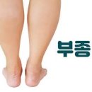 신장이 안 좋으면 나타날 수 있는 증상 원인은? 조심해야 할 음식 이미지