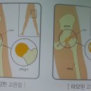 인공관절수술잘하는곳에서 알려주는 인공관절치환술, 고관절수술, 고관절통증 이미지