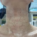 목인한의원 | 편평 사마귀 제거 과정 (3) : 한의원 거우침 후기 #1