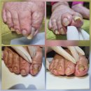 골든프라자7 | 안산발톱무좀 할머니 두꺼운 발톱 깔끔히 골든풋페디크루엘리아나