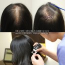 모발을 채우다 이미지
