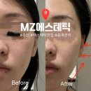 춘천중학교 | 춘천 수기관리 맛집 MZ에스테틱 너무만족한 윤곽관리 솔직후기 광대 중안부 볼쳐짐
