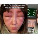 알레르기 이미지