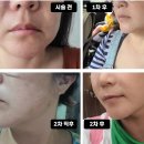 얼굴 처짐 마리오넷주름 많이 좋아졌습니다 히든브이주사 시술 후기