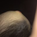 이마 혹이 가라앉다 다시 커지는데 괜찮을까요? 이미지
