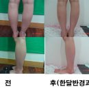 ☆(여 20대초반) 종아리 보톡스+HPL 전후사진입니다. 이미지