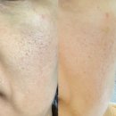 여드름 흉터 완화하고 싶다면, 인셀덤으로 해결