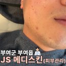 부여 새시장 | [부여피부관리] 문제성 피부관리로 방문한 JS메디스킨 압출 진정관리 후기 여드름성 피부