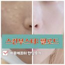 명동피부과 리쥬란을 이을 차세대 스킨부스터 필로드 비포에프터 한달후기