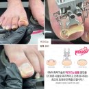 [공지] ᰔᴍɴɪ ᴇᴅᴜᴄᴀᴛᴏʀᰔ 파고드는 발톱, 내성발톱, 문제성 발톱! 앙뚜에서 완벽 케어
