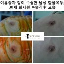 [남성 함몰유두 수술전후] 여유증과 같이 수술한 남성 함몰유두; 30세 회사원 수술직후 모습_1 이미지