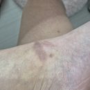 오가멍 | 자취생 얼굴 멍 빼는 법 아나시스 멍크림 도움을 받은 후기