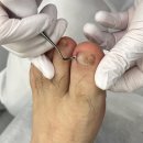 [대구] 달서구 문제성 발톱 무좀 관리 후기 : 비치아이 앤 패디