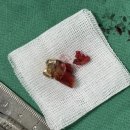 비우고채우는치과의원 | [아산 연세원치과]"기둥 세운 치아 부러짐, 다시 붙일 수 있을까?" 재부착이 어려운 의학적 이유