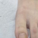 베어네일(Bear nail) | 진주 발톱무좀 발각질 동시에 해결했어요! 후네일 &amp; 베어진주장대점