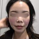 해율한의원 | 홍대 해율한의원 여드름흉터관리 솔직후기