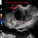 Hemorrhagic cyst of Ovary 이미지