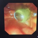 역행성담췌관 조영술(ERCP) 시술 후기