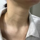 임신과 출산후 생긴 쥐젖제거하기(X혐오주의X)