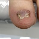 평촌의료기 | 안양 평촌역 무좀발톱 케어 잘하는 곳 미엘네일 동성제약 풀리메디 범계점