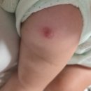 심낭골 | BCG접종 불주사 피내용, 도장형 경피용 차이 / 접종 후 관리