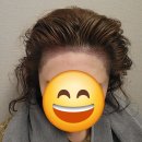 헤어스토리(hair story) | 나의 일터 최고의 복지! 모발이식(헤어라인 교정)