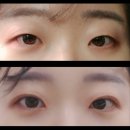 성형 - 무쌍에서 속쌍으로! 비절개 매몰, 눈매교정, 앞트임 후기!!(루호성형외과 내돈내산 찐후기 )