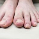 평촌뉴비뇨기과의원 | 고양시 화정 내성발톱 교정 발톱 통증 때문에 병원 다녀왔어요!