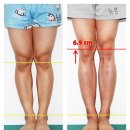 ■ 키크는수술 후기 - 성장호르몬주사 효과못봤어요 이미지