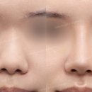 노트성형외과의원 | 복코 교정으로 중안부 함몰감까지 해결한 20대 남성 리얼 후기 by 신논현역 바이브 성형외과 유영문 원장