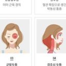 편두통 심할때 원인 왼쪽 오른쪽 이 다를까? 이미지