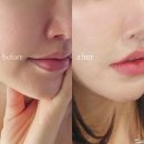 안양 범계역피부과 쥬브젠 시술후기 자연스러운 쁘띠 자가진피재생술 ft. 통증 비용 효과 후기