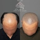 일쓸명작 나도 화가다 | 정수리 탈모, 화가의 눈으로 완성한 삭발 두피 디자인｜서울·홍대·여의도·목동 루브르스칼프
