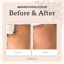 제이뷰티라운지 | 대구 죽전역 JB뷰티라운지 주근깨 관리 트라이엄 후기 톤업관리 색소 관리