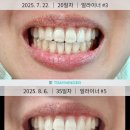 바이트리 | 인비절라인 라이트 오픈바이트 재교정 후기(1일~36일차)
