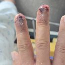 수앤수병원 | 손가락 절단 사고 후 수지접합 수술 및 회복 과정과 3주간의 간병 기록#3(사진 주의)