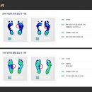 평발교정 깔창 효과는 어떠나 이미지