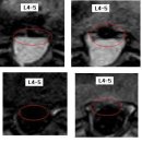 왈왈이님의 허리디스크 L4-5 MRI 판독입니다. 이미지
