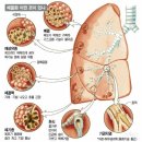 만성ㆍ급성 기관지염 이미지