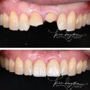 김동건바른치과의원 | 답일까요? 치아 신경치료와 교정적 정출술로 자연치아를 살리기- 인천 부평 김동건 바른치과의 치료 증례