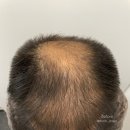 송파두피문신, 모발이식 후 정수리 밀도 보강 후기