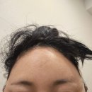 애기야 | 신논현역 이중턱살제거 투턱없애기 후기