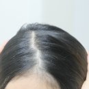 이브헤어라인 - 북구 | 헤어라인 탈모고민 릴리이브 그로우턴 엑소좀 스피큘 앰플 정수리 일주일 사용후기